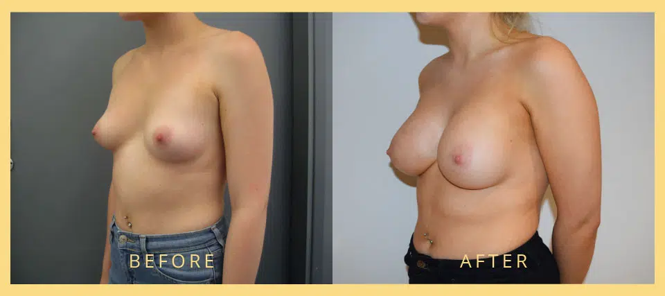 breast implant surgery london