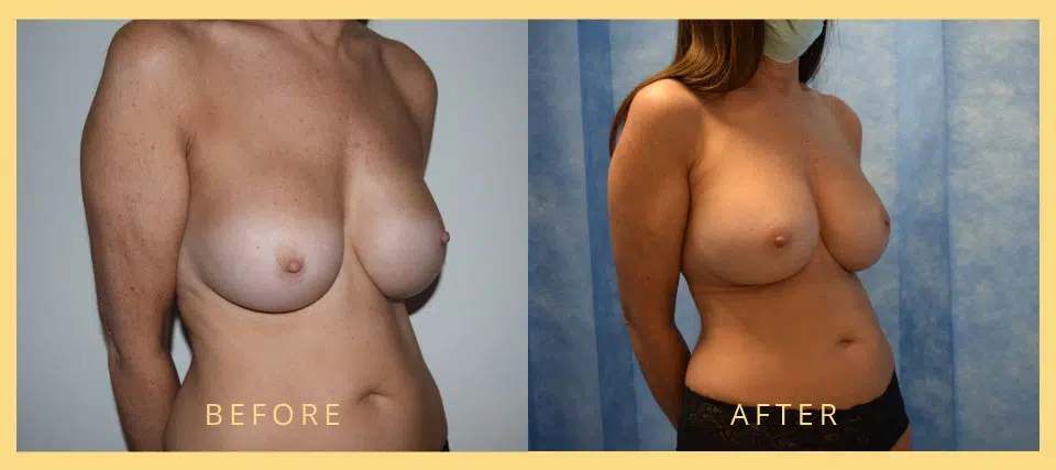 breast implants revision before after