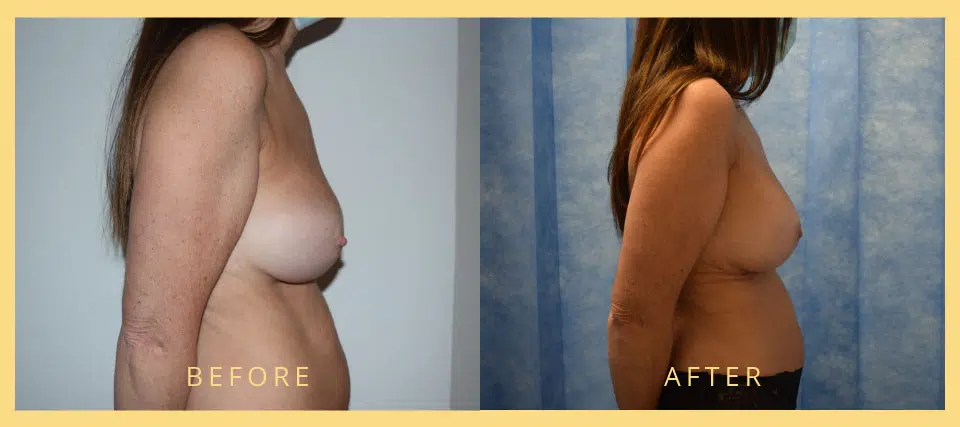 breast implants revision before after