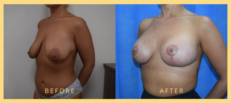 breast lift before after