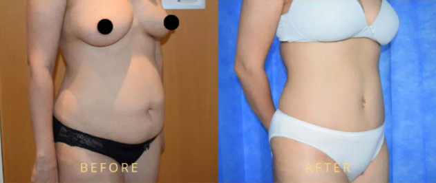 flank_liposuction_before_after