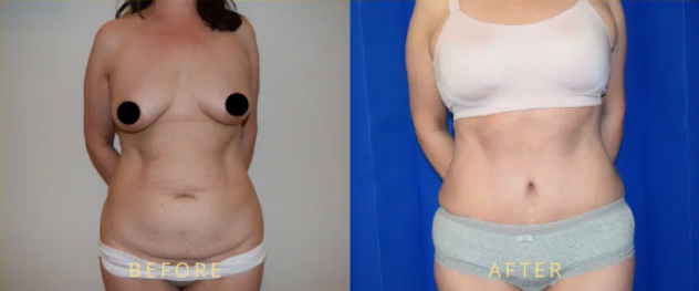 flank_liposuction_before_after_1