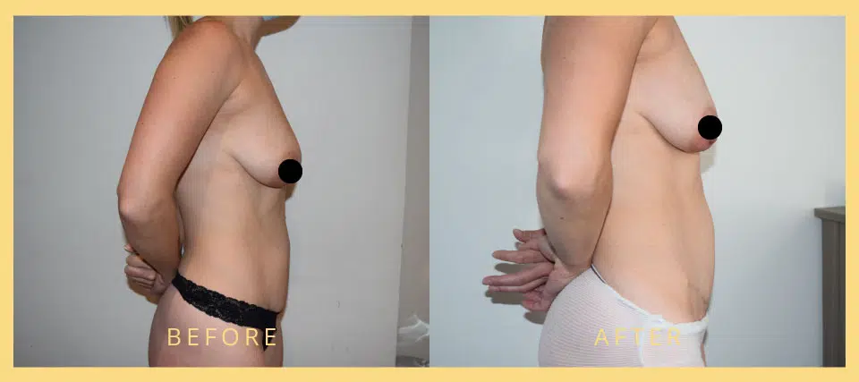 mini tummy tuck before after