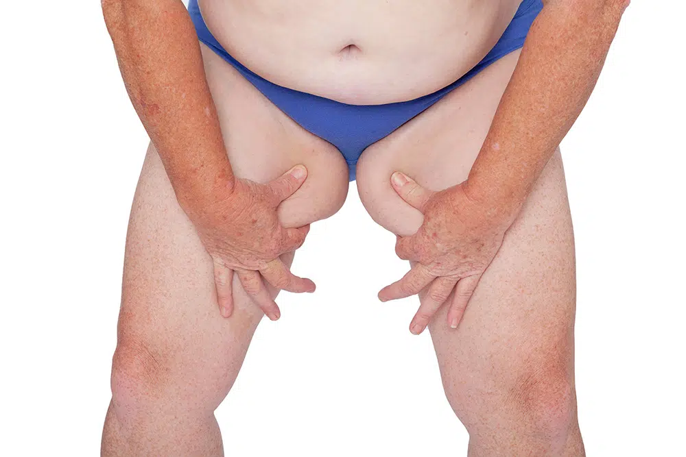how to tighten loose skin on inner thighs